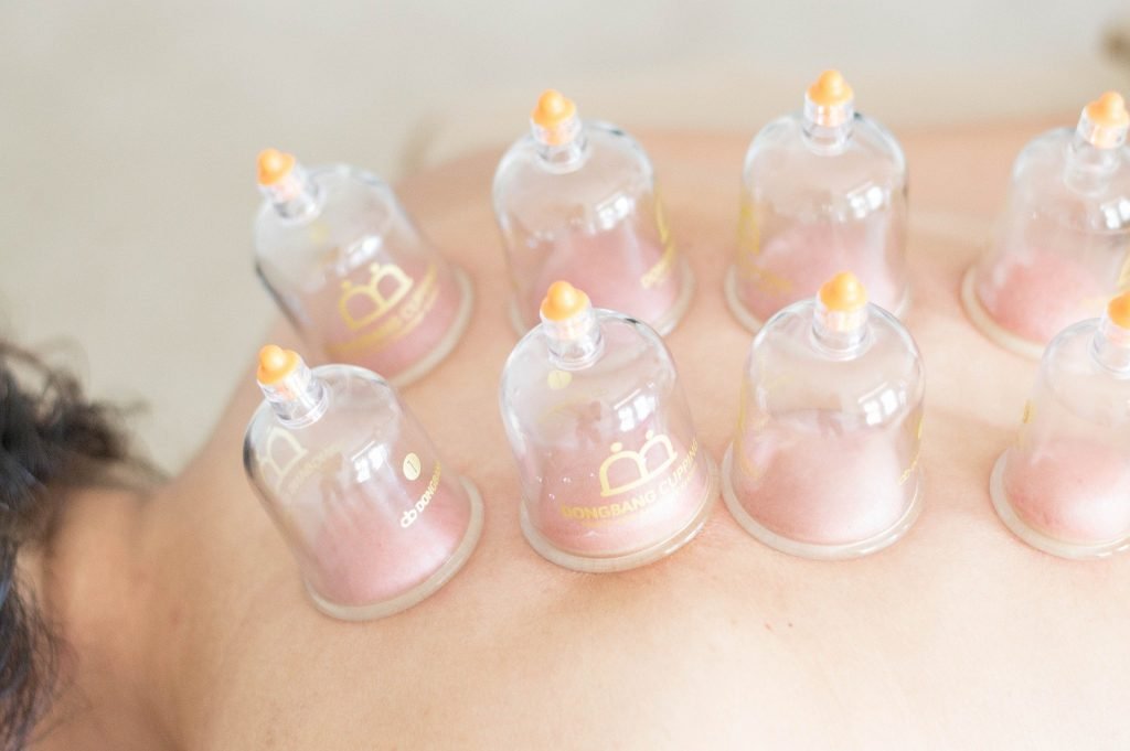 eight cups on patient's back during cupping treatment